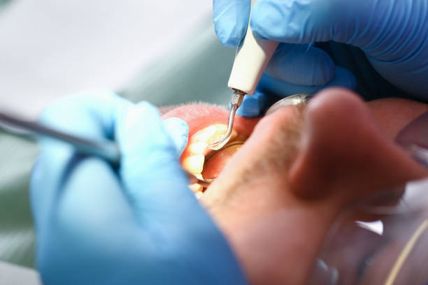 Best Emergency Treatment for Dental Infections or Abscesses in Trumansburg, NY